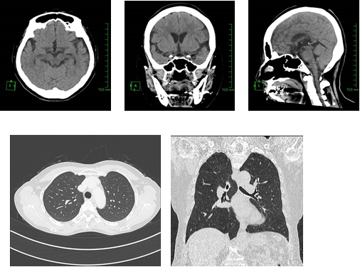ct3