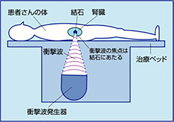 EDAP社製 Sonolith Vision1